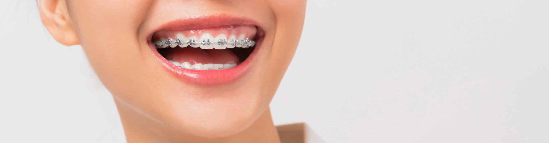 Smiling woman with braces.